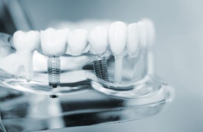 Implantologia-dentale